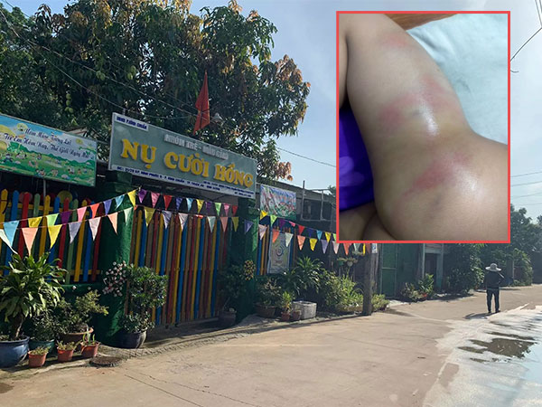 Bé gái 4 tuổi bị cô giáo đánh tím người vì đi vệ sinh ra quần