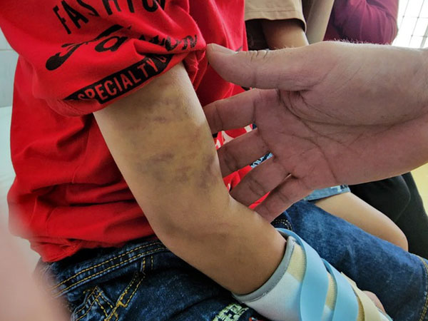 Vụ cháu bé 9 tuổi bị đánh đập dã man: Phát hiện xương bàn tay bị gãy