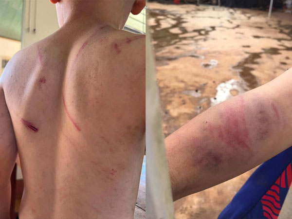 Vụ cháu bé 9 tuổi bị bà và cha đánh đập dã man: Người mẹ nói gì?