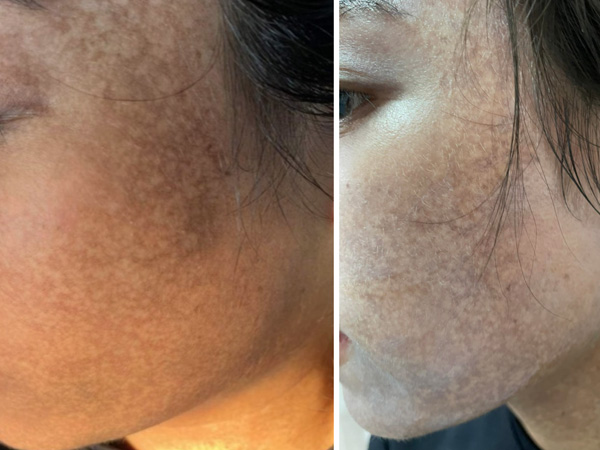 Mặt cô gái trẻ 'cháy đen' sau khi chi 70 triệu đồng để lăn kim, lột da trị nám tại spa