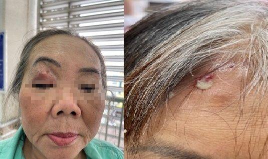TP.HCM lập hội đồng chuyên môn, tìm nguyên nhân gây 'chết xương'