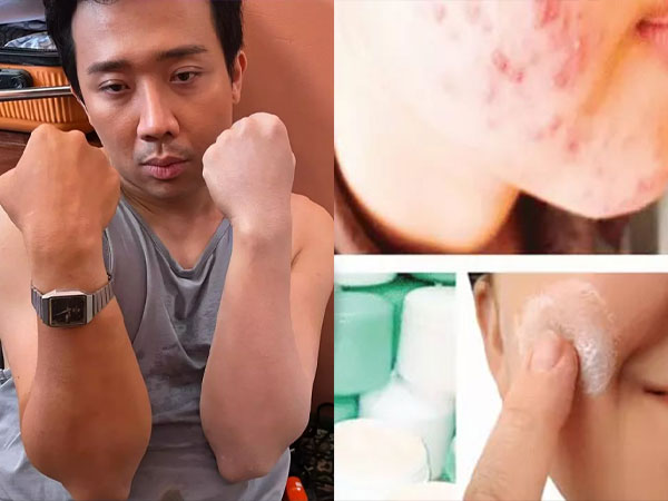 Trấn Thành gặp 'nạn' vì bôi kem trộn
