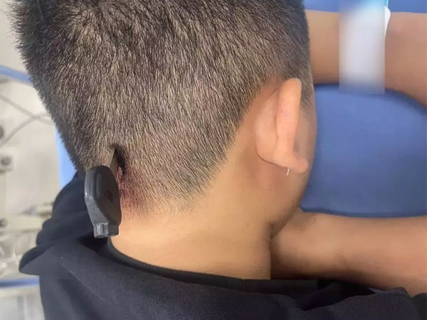 Cấp cứu kịp thời nam thanh niên bị chìa khóa xe máy cắm vào đầu