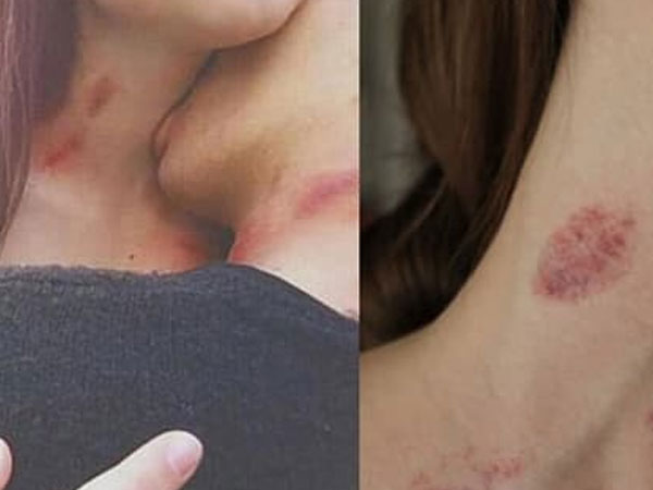 Cô gái 23 tuổi qua đời đột ngột sau khi hôn bạn trai, bác sĩ cảnh báo 1 việc đàn ông dù thích mấy cũng đừng làm với bạn gái