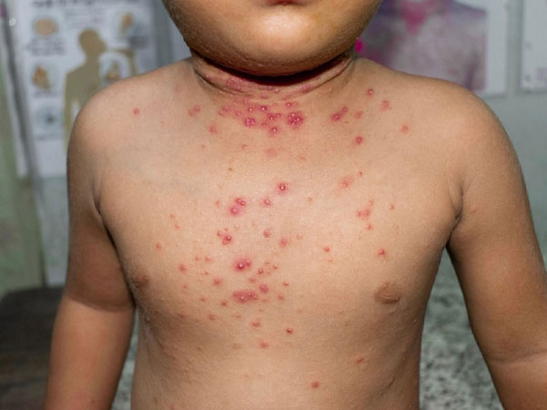 Mỹ lo thiếu vaccine ngừa virus đậu mùa khỉ