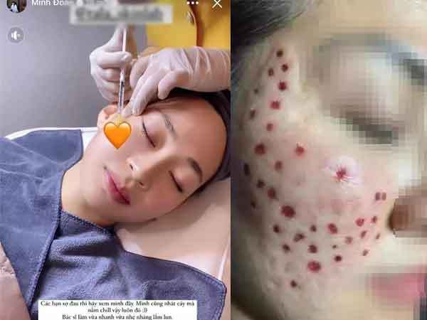 Bất chấp có thể bị biến chứng, một hot girl liều mình tiêm meso