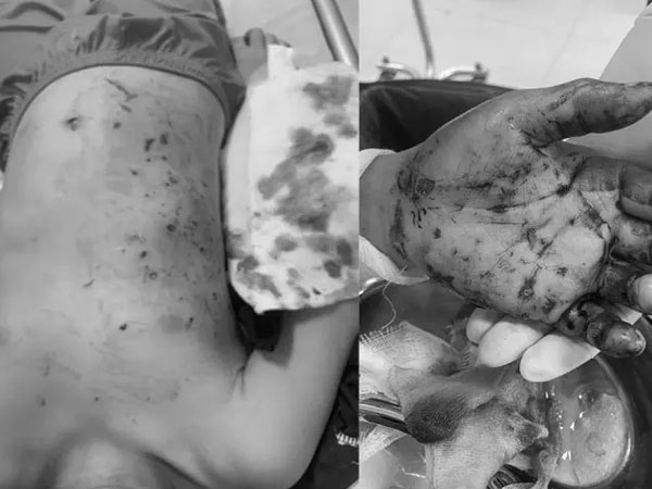 Pin đồ chơi bất ngờ phát nổ, mảnh vỡ văng đầy người trẻ 10 tuổi