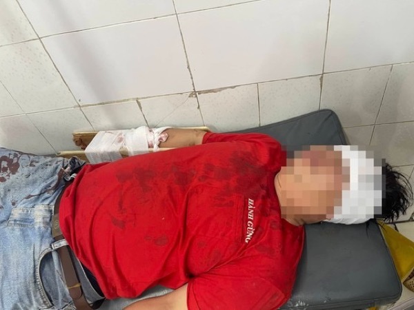 Tranh cãi chỗ đỗ xe, nhân viên quán karaoke chém đứt lìa tay khách