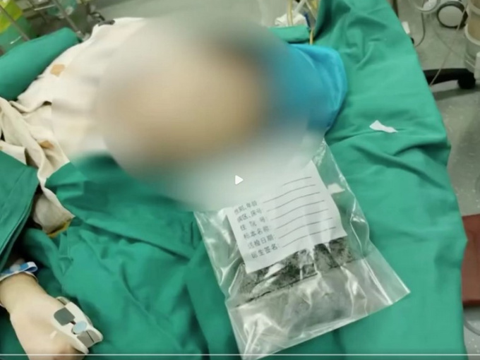 Bé gái ăn gần 1kg tóc để được cha mẹ quan tâm