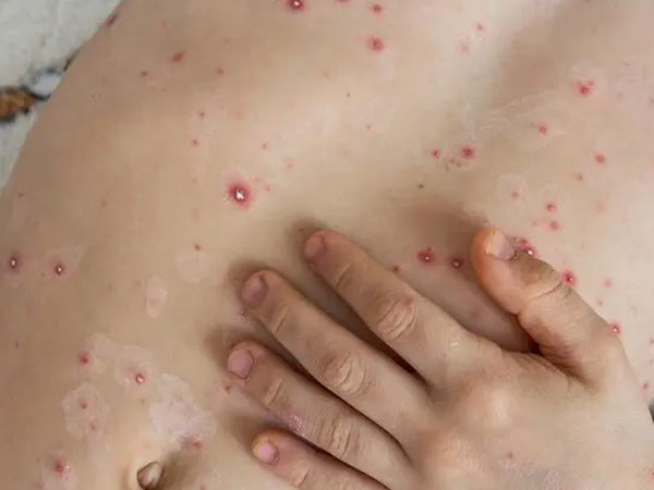 Virus 'cúm cà chua' lây nhanh ở trẻ em nguy hiểm sao?