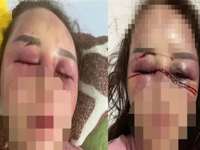 Cán bộ QLTT đánh bạn gái dập mũi, vỡ hàm, chảy máu mắt vì hát song ca với người khác
