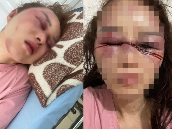 Vụ cán bộ QLTT Thanh Hóa đánh bạn gái dã man: Nạn nhân phải phẫu thuật và theo dõi thêm phần não
