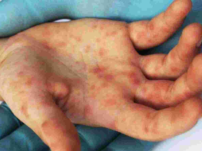 Ấn Độ cảnh báo xuất hiện loại virus mới gây bệnh 'cúm cà chua'