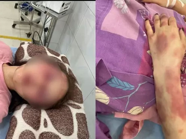 Vụ cán bộ QLTT bị tố đánh đập, lột đồ người tình: Vì sao chưa thể giám định thương tật nạn nhân?
