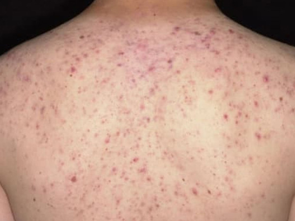 Rối loạn ý thức, suýt tử vong sau 30 phút lăn kim trị mụn ở lưng tại spa