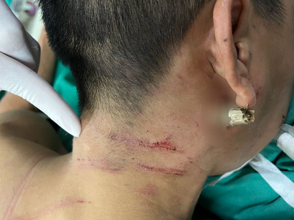 Ngã xe máy, nam thanh niên bị thanh tre đâm xuyên cổ