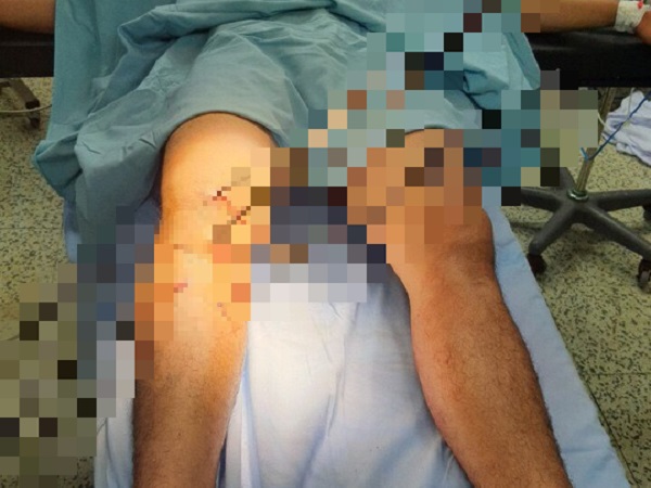 Kinh hoàng cảnh thanh niên bị 5 cây sắt đâm xuyên qua chân