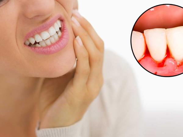 Chảy máu chân răng - Dấu hiệu cảnh báo nhiều bệnh nguy hiểm