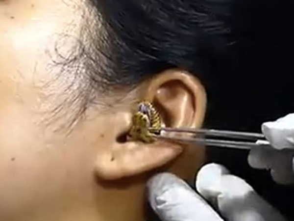 Xôn xao clip rắn chui vào tai người không chịu ra