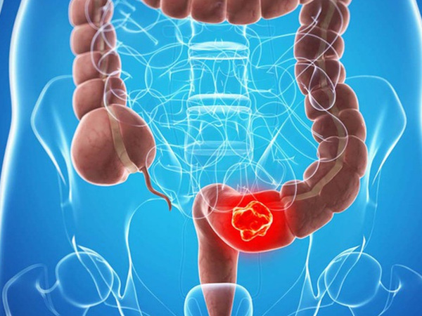 Đi ngoài ra máu, thanh niên 17 tuổi đã bị ung thư trực tràng di căn