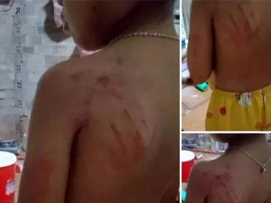Học sinh lớp 1 bị cô giáo đánh bầm tím vai vì viết chậm