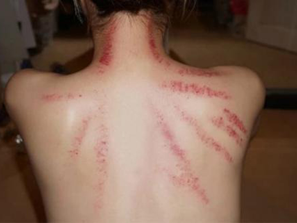 Phát hiện bạn gái cởi áo để anh trai kết nghĩa cạo gió hộ, nam thanh niên thắc mắc một chuyện khiến dân tình ngã ngửa: 'Ngây thơ quá vậy!'