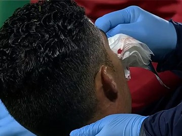 Ronaldo 'tịt ngòi', đổ máu, khiến Bồ Đào Nha bị thổi phạt đền