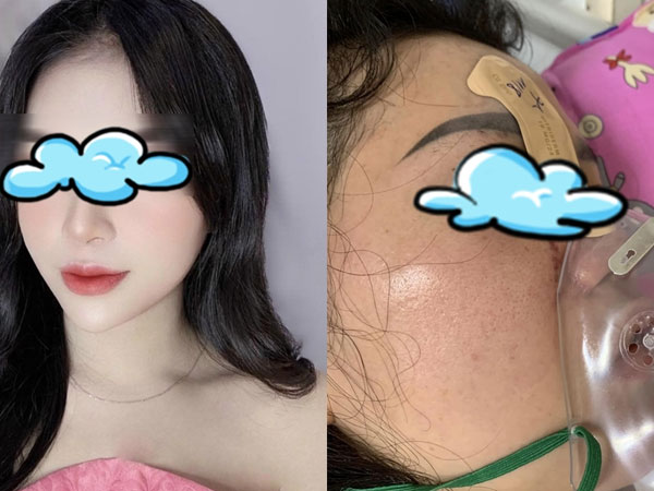 Cô gái 27 tuổi bị mù mắt sau khi tiêm filler nâng mũi: Là mẹ đơn thân nuôi 2 con nhỏ, may mắn giữ được tính mạng