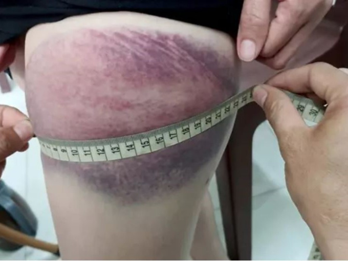 Bảo vệ dân phố cầm gậy đánh hàng xóm bầm tím