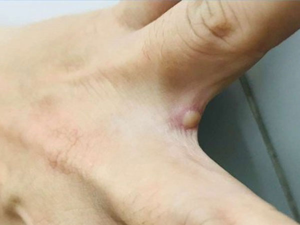 Sức khỏe của bệnh nhân mắc đậu mùa khỉ đầu tiên ở Việt Nam hiện ra sao?