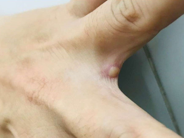 Hình ảnh vết mụn nước ở người mắc đậu mùa khỉ đầu tiên của Việt Nam