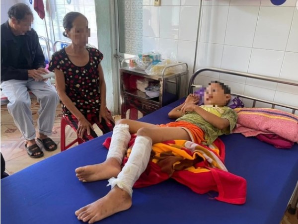 Nghi trộm tiền, cháu bé học lớp 3 bị cha ruột dùng rơm và xăng đốt bỏng 2 chân