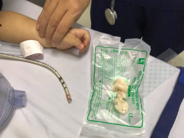 Bé trai 22 tháng tuổi ngưng tim, ngưng thở vì hóc thạch rau câu
