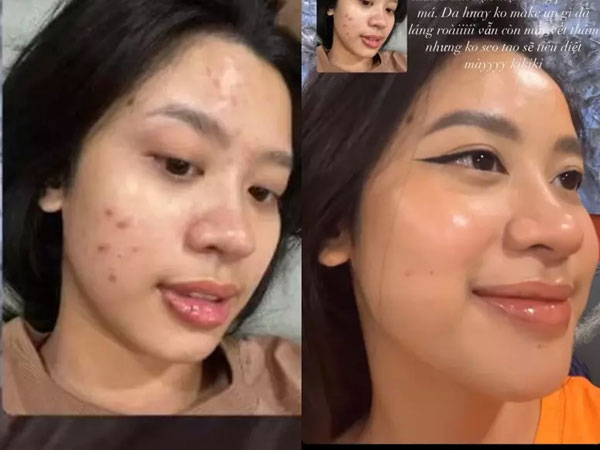 Ngã ngửa mặt mộc chi chít mụn hot girl nổi tiếng gốc Thanh Hóa