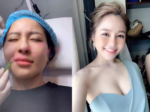 Trâm Anh gây hãi vì khoe cận cảnh tiêm mặt xóa rãnh cười