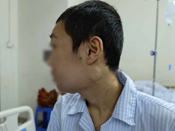 Sưng đau chân, acid uric tăng tưởng do gút, hoá ra mắc ung thư máu