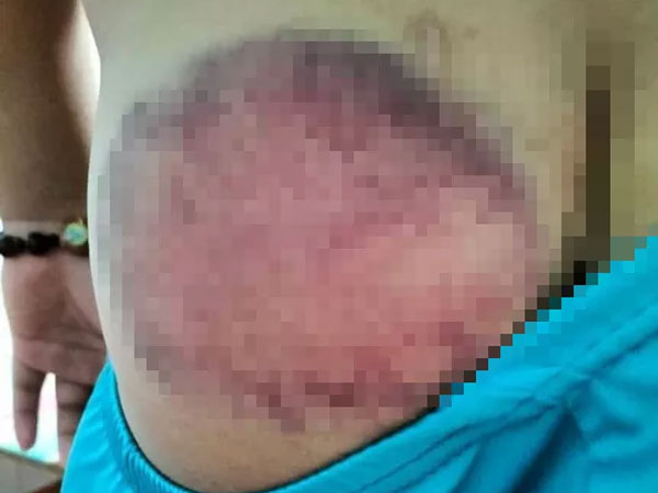 Học sinh tiểu học bị giáo viên đánh bầm tím mông vì nghịch, quên mang sách