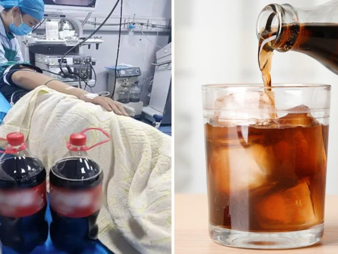 Bác sĩ Trung Quốc gây sốt mạng xã hội vì đề nghị bệnh nhân uống Coca-Cola để chữa sỏi dạ dày