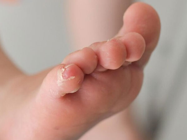 Trẻ mới 2 tháng tuổi bị hủy xương, viêm màng não vì lây giang mai từ mẹ