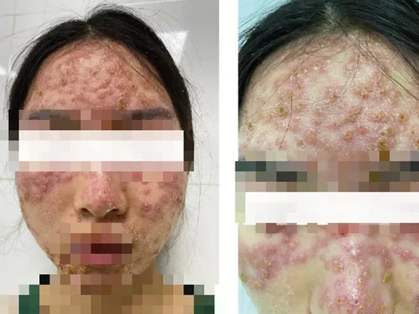 Bôi kem 'detox' trị mụn ở spa, cô gái trẻ ôm mặt chi chít mụn nước, đau rát đến viện cầu cứu bác sĩ