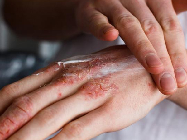 Da khô ráp, nứt nẻ, chảy máu vào mùa lạnh phải làm sao?