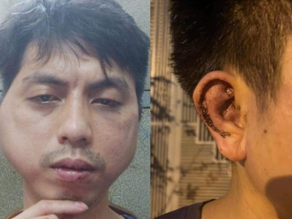 Khởi tố vụ chủ quán lẩu ở Hà Nội đánh biến dạng khuôn mặt nhân viên