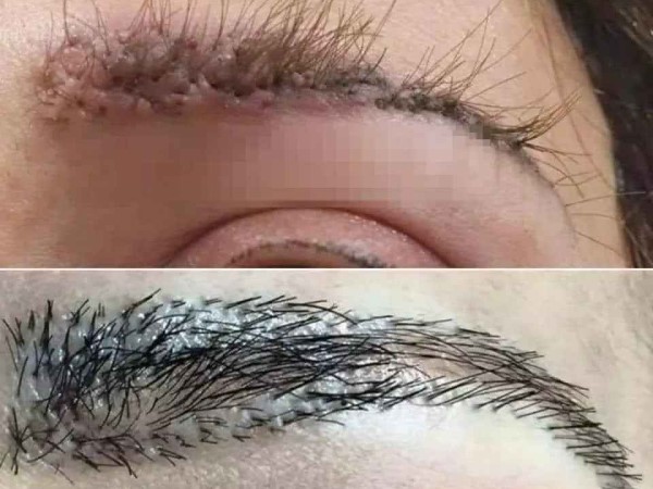 Cấy lông mày người phụ nữ nhận cái kết đáng sợ