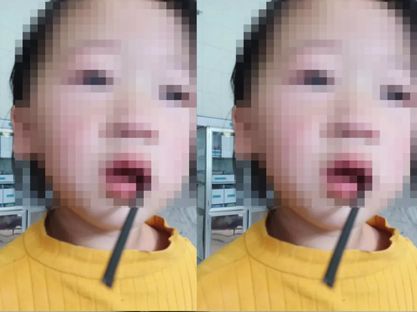 Bé gái 4 tuổi bị thanh sắt đâm vào khoang miệng: Cảnh báo các bậc cha mẹ chú ý trước những vật dụng nguy hiểm