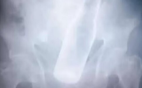 Vỏ chai bia mắc kẹt trong hậu môn, cụ ông đổ lỗi cho... trộm