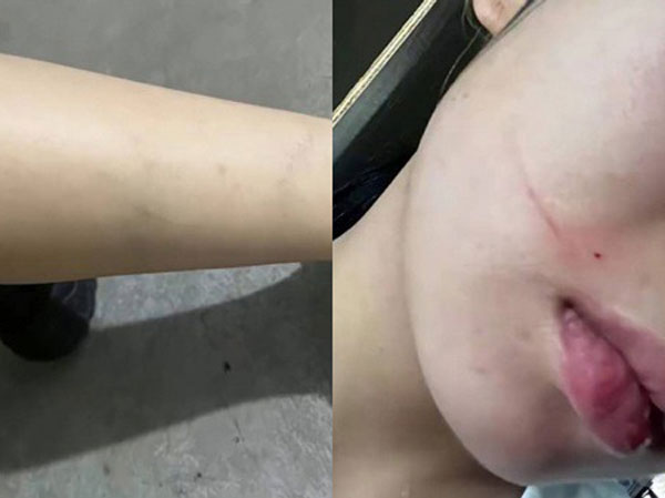 Bầu 7 tháng, thai phụ bị chồng bạo hành đến mức không đi lại được mới dám gọi về cho bố mẹ đẻ