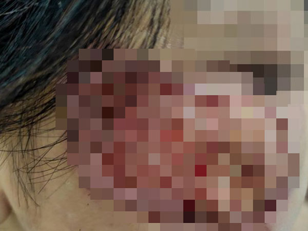 Mua 'thuốc chứa axit' trị nám: Chưa đẹp đã loét mặt