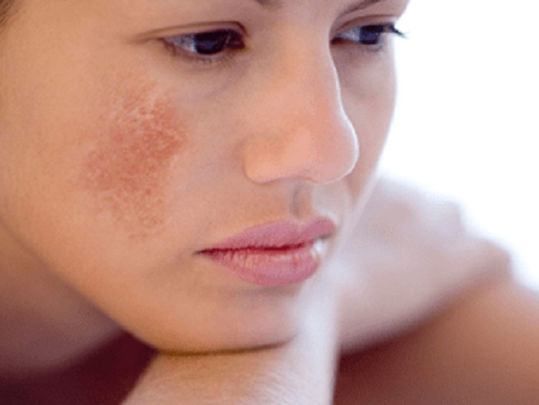 Mua 'thuốc chứa axi' trị nám: Chưa đẹp đã loét mặt