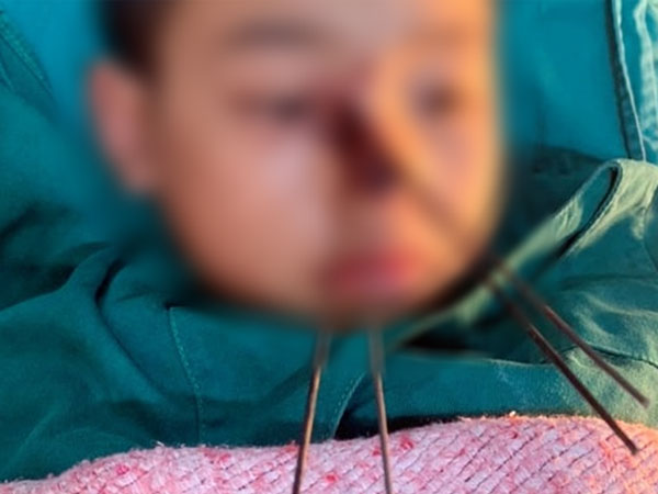 Cầm nỏ tự chế đi bắt chuột, bé trai 11 tuổi bị 4 mũi tên sắt găm vào vùng mặt