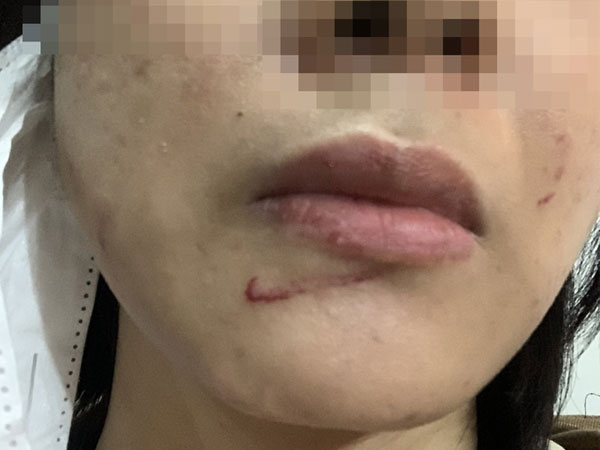 Phó trưởng công an xã đánh vợ cũ nhập viện